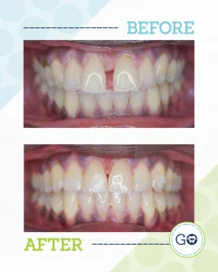 Before and After Invisalign Smile Gallery - Smile Design Charleston