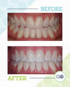 Before and After Invisalign Smile Gallery - Smile Design Charleston