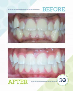 Before and After Invisalign Smile Gallery - Smile Design Charleston