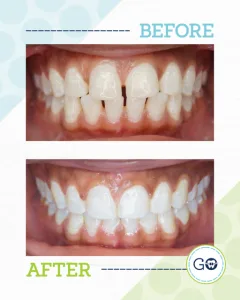 Before and After Invisalign Smile Gallery - Smile Design Charleston