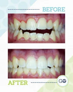 Before and After Invisalign Smile Gallery - Smile Design Charleston